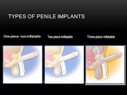 types-of-penile-implants-02