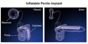 penile-implant-specialists-nyc-02